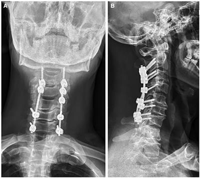 Drug fever induced by antibiotics of β-lactams in a patient after posterior cervical spine surgery—A case report and literature review